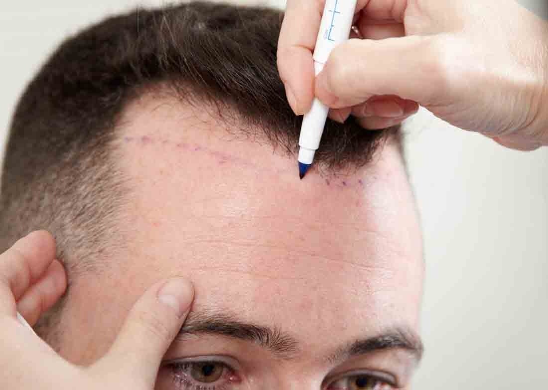 hair transplant in delhi